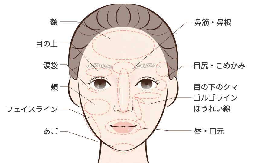 ヒアルロン酸注入の代表的な部位のイメージ