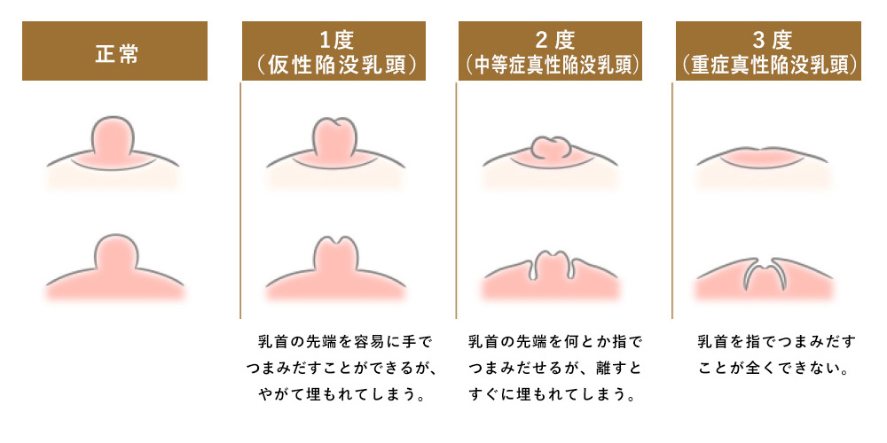 陥没乳頭のレベル（正常・1度・2度・3度）