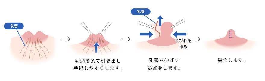 乳管温存法（軽度〜中等度）の手術手順イメージ