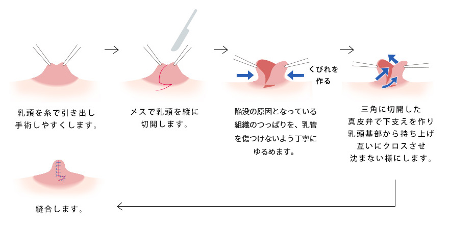 乳管温存コンプリート法（重度）の手術手順イメージ
