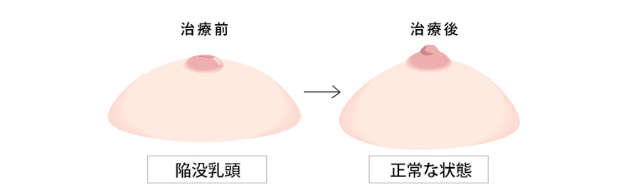 陥没乳頭の治療前後のイメージ