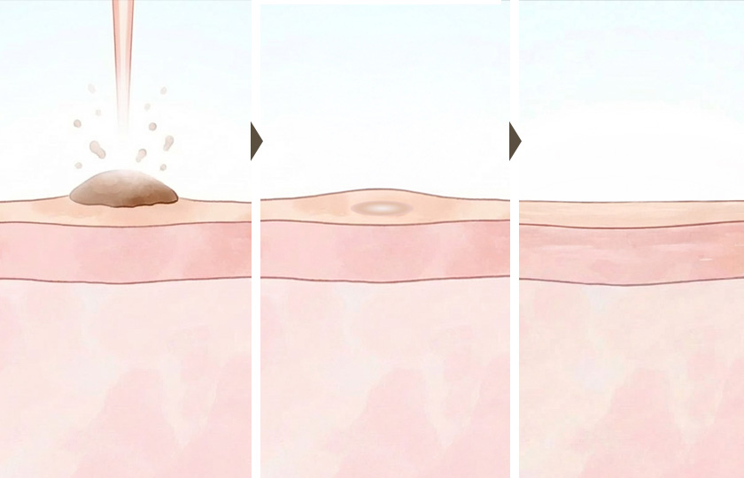 CO2レーザーのイメージ