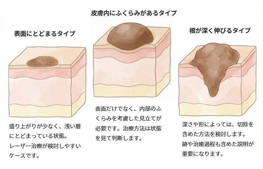 ほくろの見立てのイメージ／左：表面にとどまるタイプ。皮膚表面に限局したほくろ・いぼ盛り上がりが少なく、浅い層にとどまっている状態。レーザー治療が検討しやすいケースです。／中央：皮膚内にふくらみがあるタイプ
皮膚の中に丸みをもって存在するタイプ。表面だけでなく、内部のふくらみを考慮した見立てが必要です。治療方法は状態を見て判断します。／右：根が深く伸びるタイプ。皮膚の深い層まで伸びているタイプ。深さや形によっては、切除を含めた方法を検討します。跡や治癒過程も含めた説明が重要になります。
