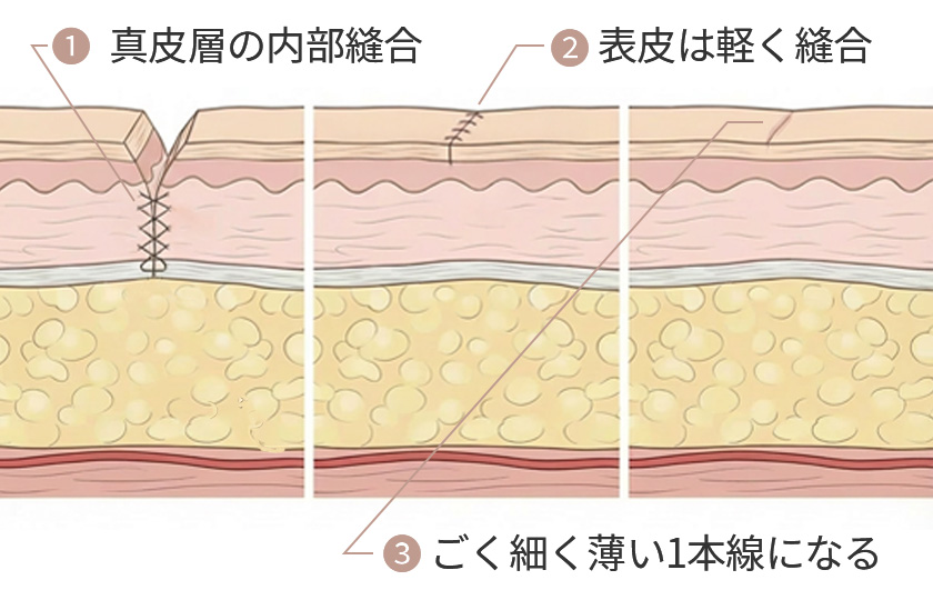 余剰皮膚の調整と縫合のイメージ