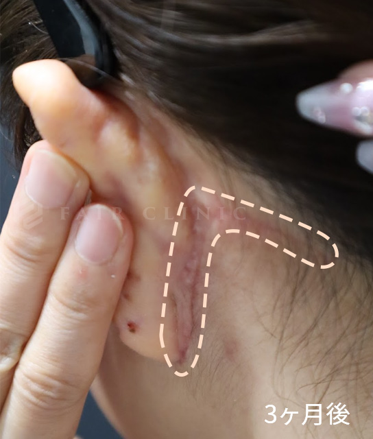 傷跡とフォローのイメージ