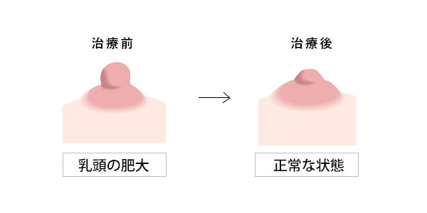 乳頭縮小のイメージ