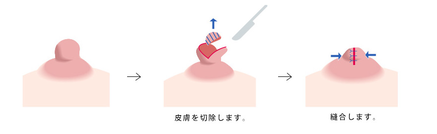 肥大乳頭：直径縮小のイメージ