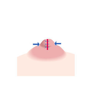 肥大乳頭：直径縮小のイメージ