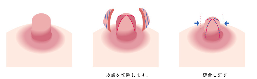 肥大乳頭：直径縮小（乳管を避ける設計例）のイメージ