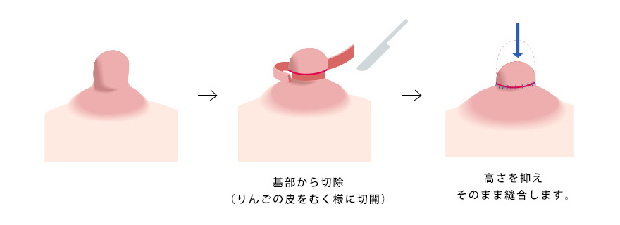 下垂乳頭形成のイメージ