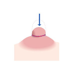 下垂乳頭形成のイメージ