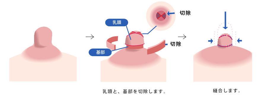 高さ＋直径縮小のイメージ