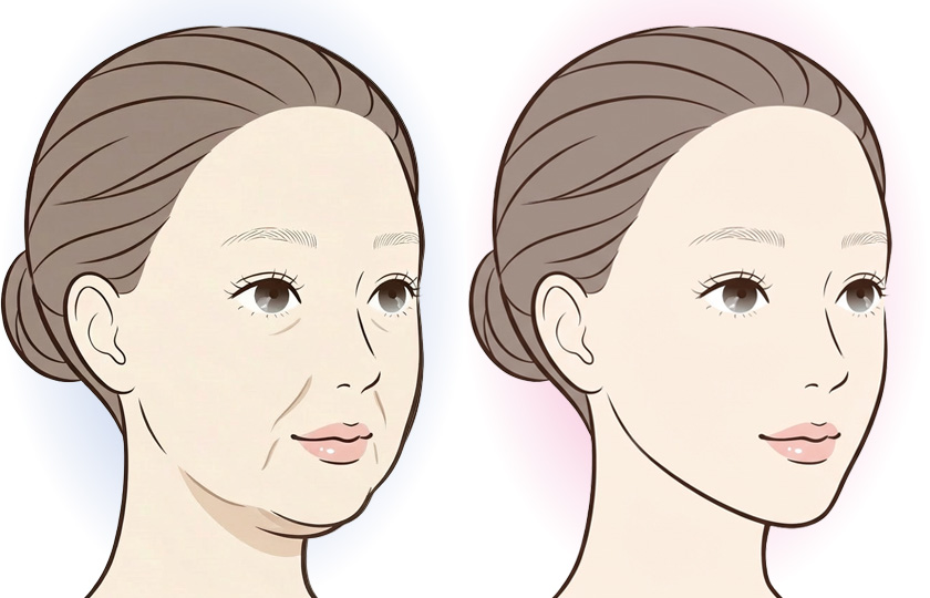 HIFU・糸リフトとの併用