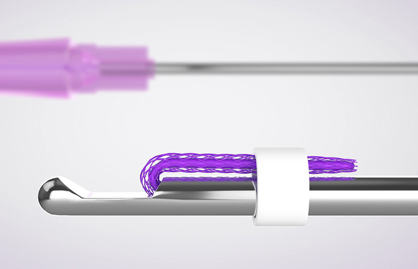 糸リフトのイメージ