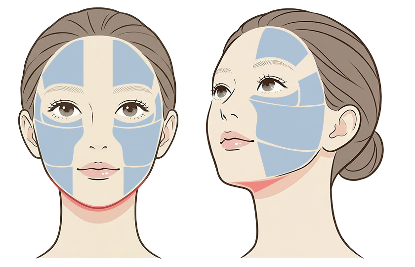 ウルセラ〈アドバンス〉の照射範囲イメージ