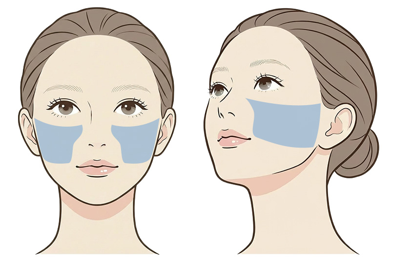 頬の照射範囲イメージ