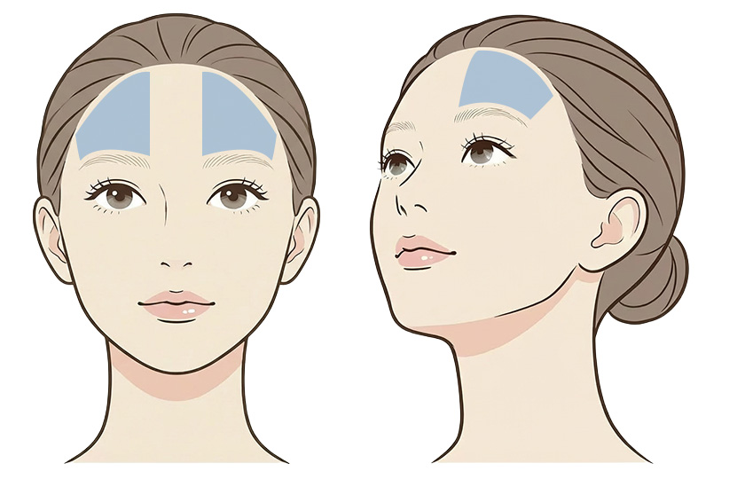 目の上ウルセラの照射範囲イメージ