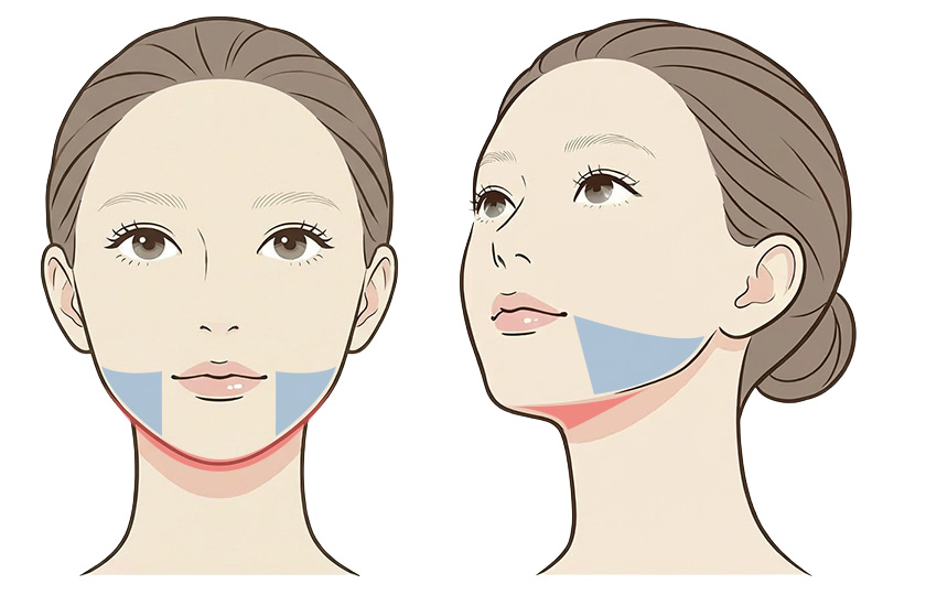 フェイスライン＋アゴの照射範囲イメージ