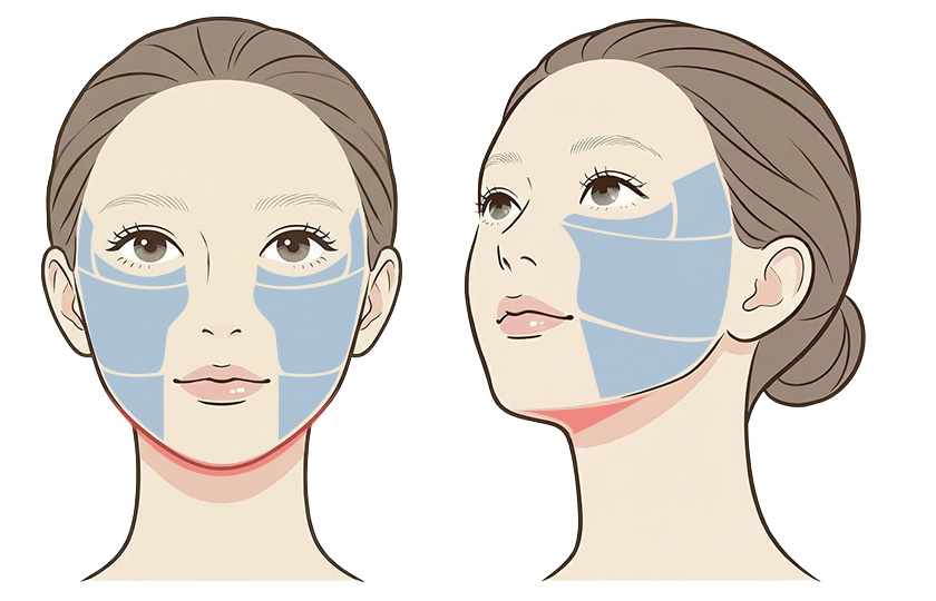 ウルセラ〈スタンダード〉の照射範囲イメージ