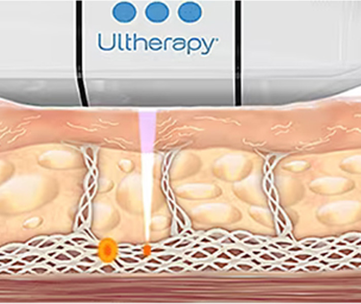 医師施術HIFU治療照射後のフェイスラインイメージ