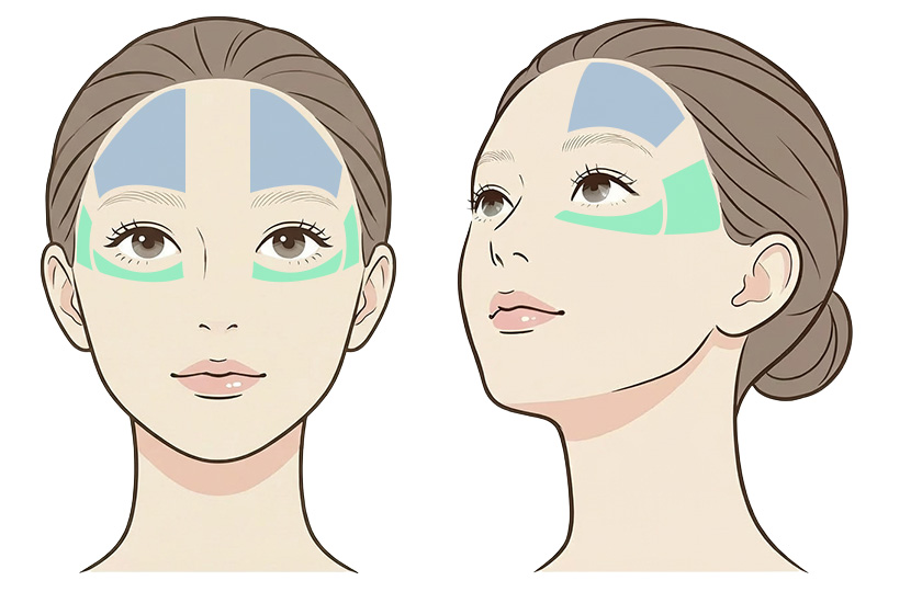 目のたるみ（上または下）の照射範囲イメージ