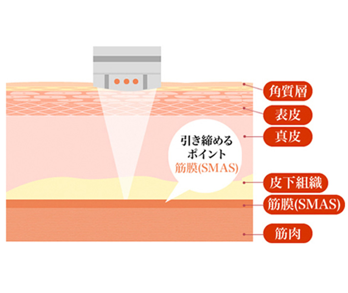HIFU治療照射後のフェイスラインイメージ