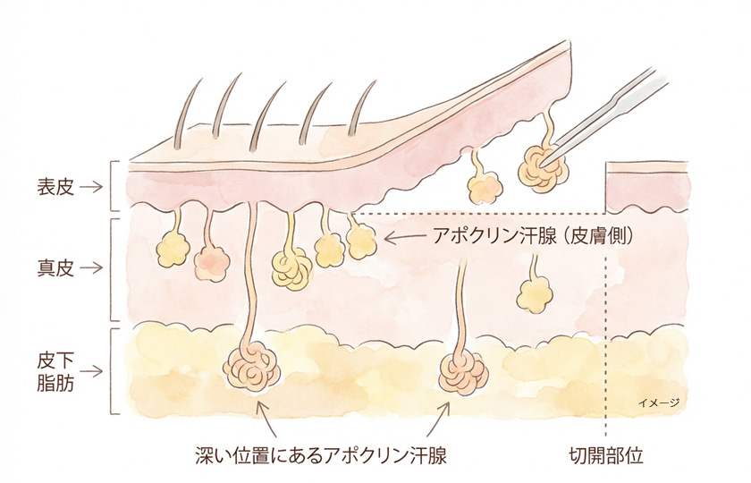 切開剪除法のイメージ