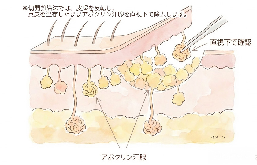 切開剪除法でアポクリン汗腺を直視下に確認しながら除去するイメージ