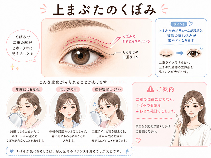 上まぶたのくぼみによって、二重の線が2本や3本に見える原因を説明するイラスト