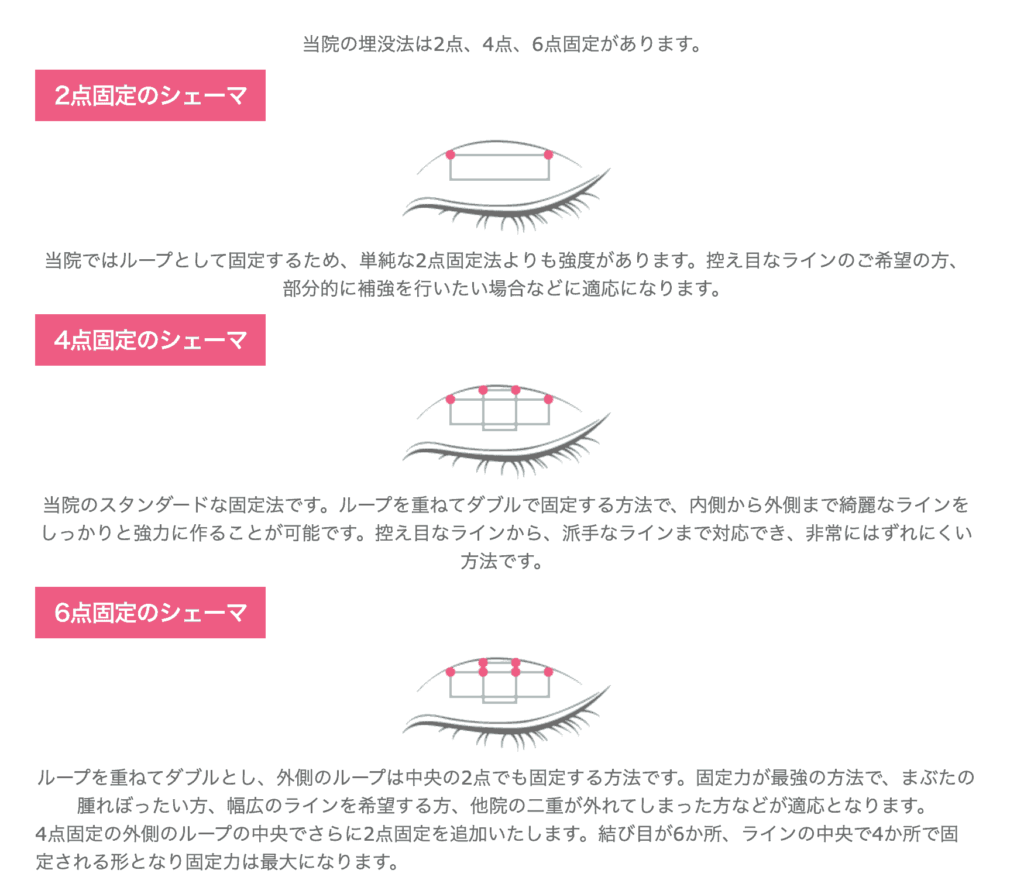 プリモ麻布十番クリニックの埋没固定方法