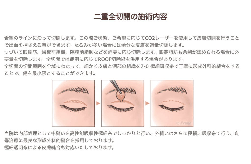 プリモ麻布十番クリニックの切開法
