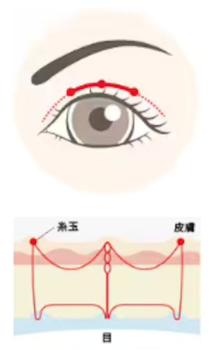 SBC二重埋没法線留め
