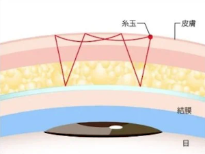 TCB 線留め1本 1dayクイックアイナチュラル