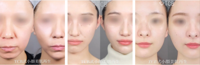 TCBの症例モニター例