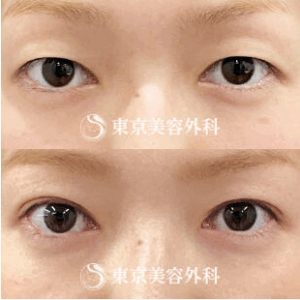 東京美容外科二重整形症例