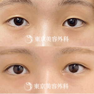 東京美容外科二重整形症例