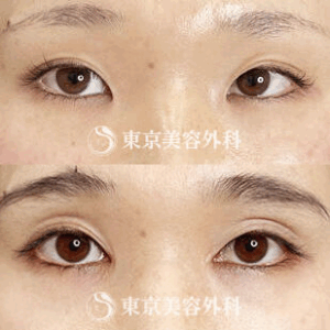 東京美容外科二重整形症例