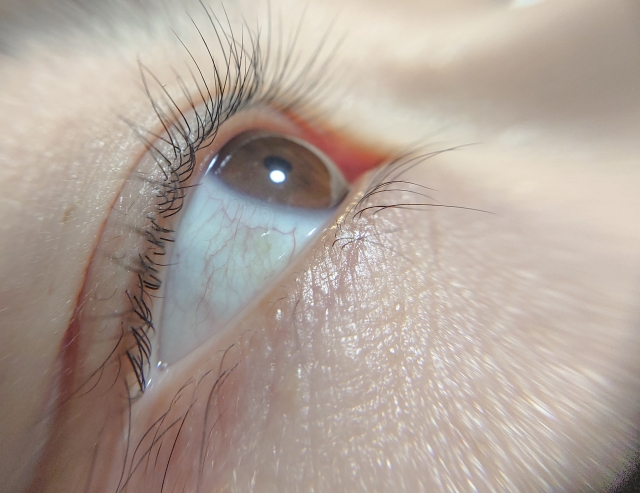 高校生でも二重埋没は受けられる？バレずに埋没を受ける方法なども紹介！