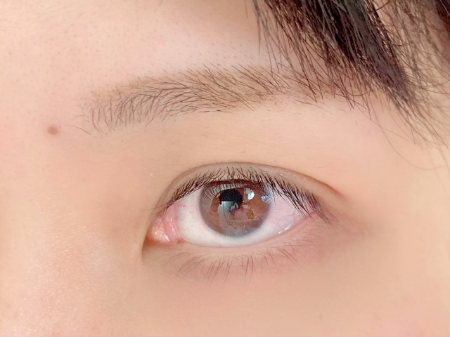 埋没法はやり直しできる？抜糸しないほうがいい？注意点や期間も解説！