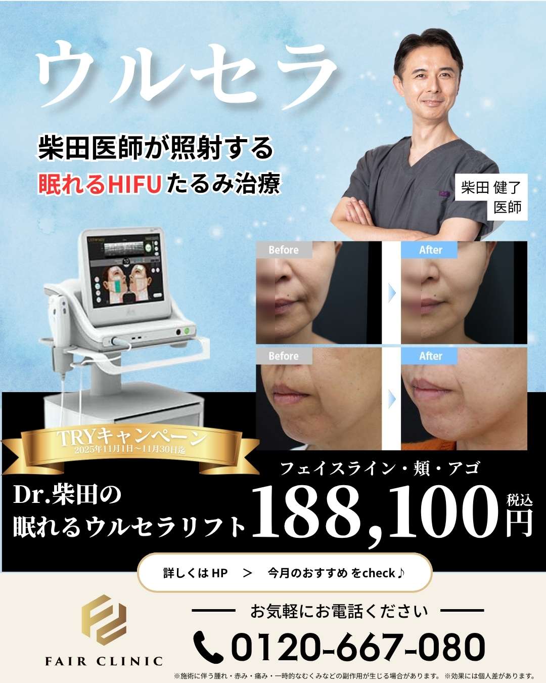 Dr柴田の眠れるウルセラリフト全顔188,100円