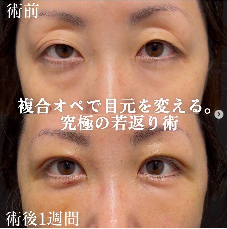 kisuiクリニックの二重整形の症例