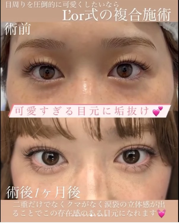 Lorクリニックの二重整形の症例