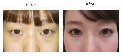 渋谷美容外科の二重整形の症例