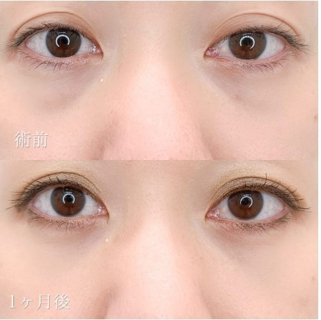 TCB東京美容外科のクマ取り再生注射の症例