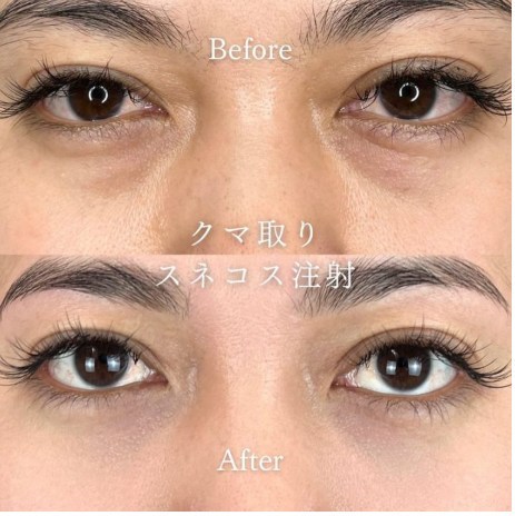 TCB東京美容外科のクマ取り再生注射の症例