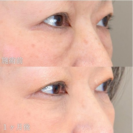 TCBクマ取りスタンダードの症例