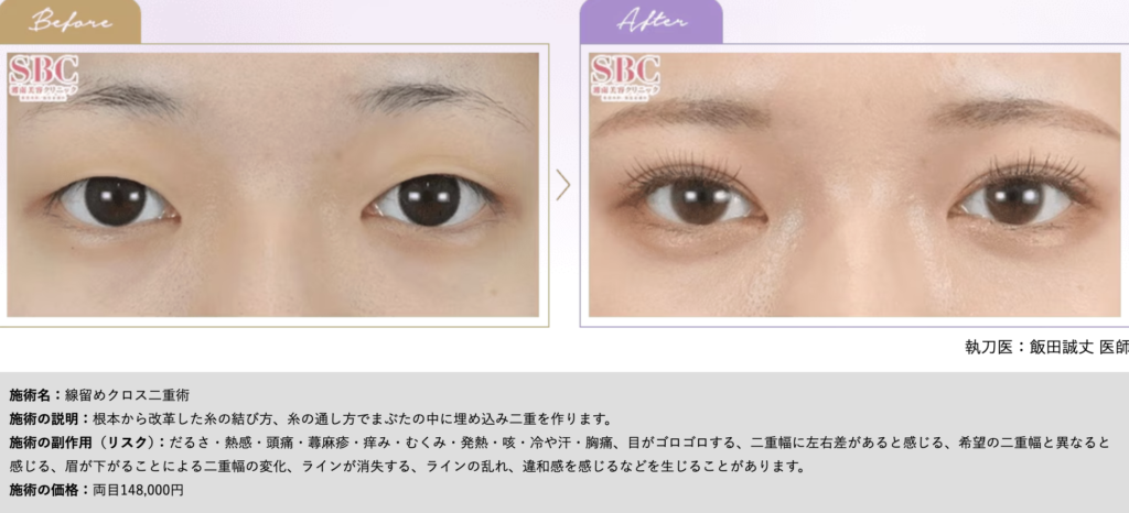 線留めクロス二重術（旧フォーエバー二重術）