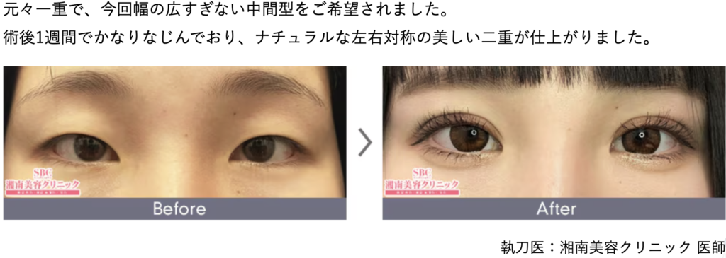 週末二重術®のビフォーアフター