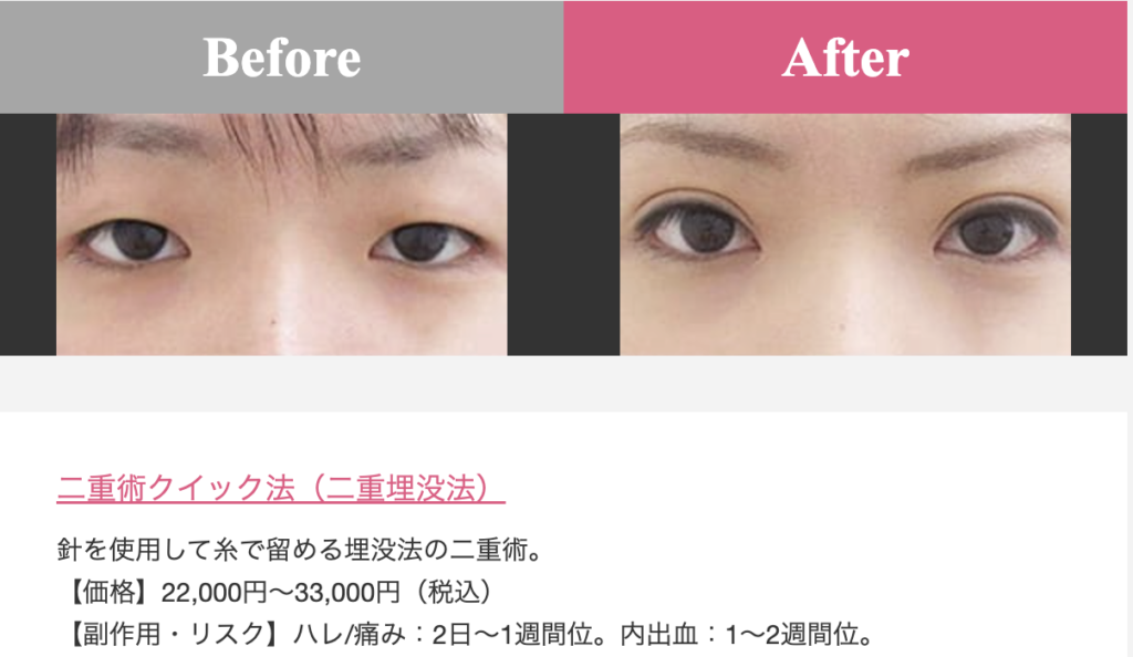 品川美容外科二重術クイック法