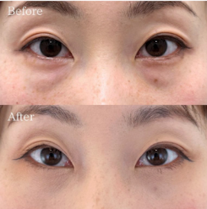 向田敦史 福岡博多院 院長 クマ取り症例 切らない目の下のクマ取り・目の下のたるみ（ふくらみ）取り 【切らない目の下のクマ取り・目の下のたるみ（ふくらみ）取りの施術概要】下まぶたの裏側を1cmほど切開し、余分な脂肪を取り除く施術です。目の下のふくらみが目立つ、疲れて見える、クマのように見えるという状態を解消します。 【切らない目の下のクマ取り・目の下のたるみ（ふくらみ）取りのリスク】まぶたの裏側を切開するので傷跡は外からはわかりません。腫れは数日～1週間でほぼ落ち着きますが、より自然な仕上がりとなるまでに1ヶ月ほど要します。 【クマ取り再生注射の施術概要】1回の注射で脂肪溶解、再生因子、注入治療成分を注入し、目の下のクマを改善します。 【クマ取り再生注射のリスク】腫れ・痛み・内出血：2日程度